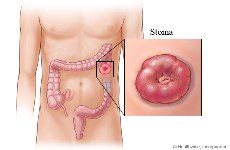 colostomy